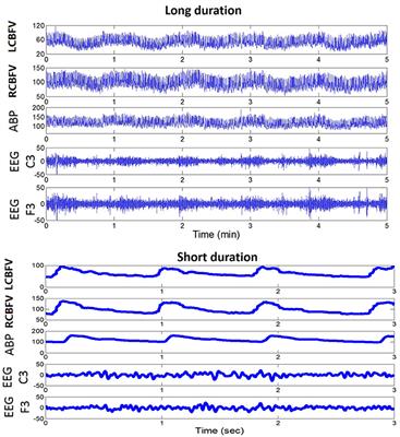 Cross-Frequency Coupling Between Cerebral Blood Flow Velocity and EEG in Ischemic Stroke Patients With Large Vessel Occlusion